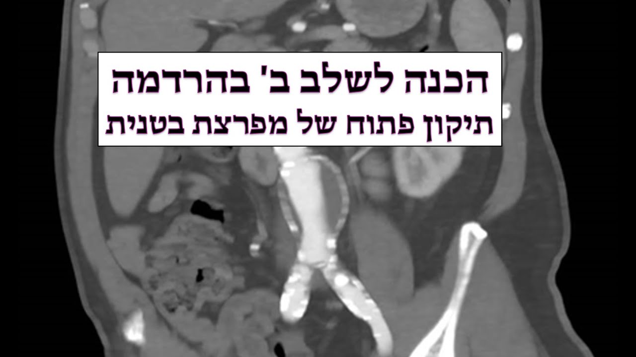 הכנה לשלב ב' בהרדמה - תיקון מפרצת בטנית עם מקס