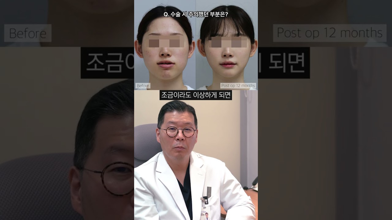 선교정하고 주걱턱 양악수술 진행한 후기! 