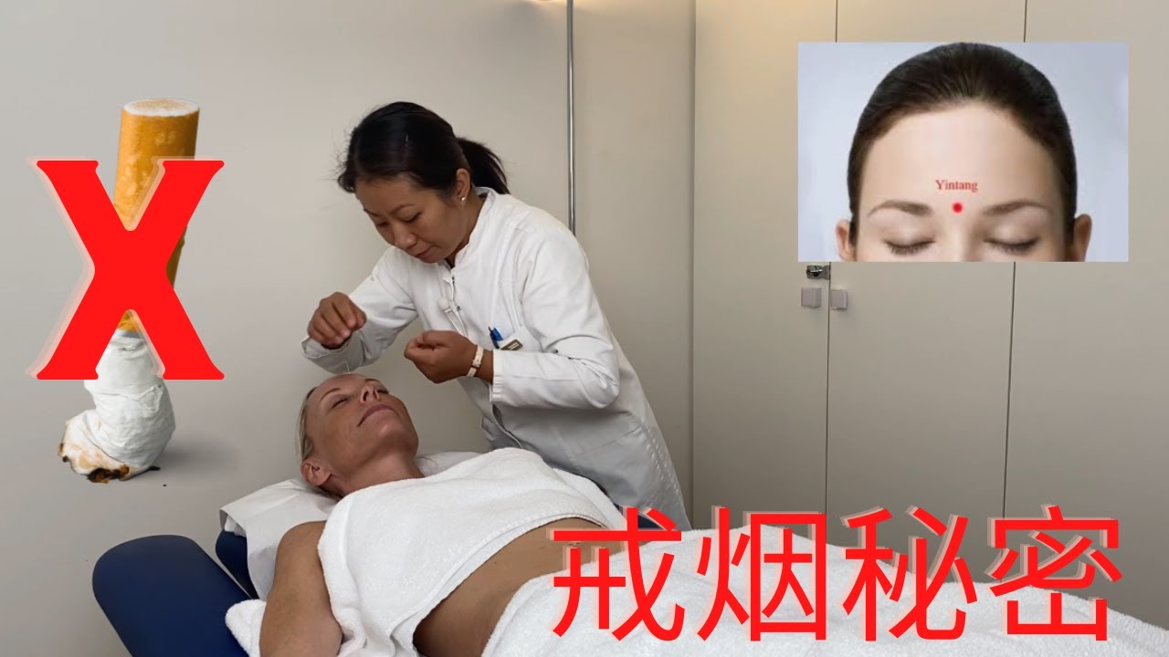 Stop cigarette- acupuncture
