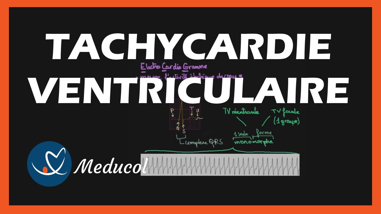 Tachycardie Ventriculaire: ECG, symptômes et traitement