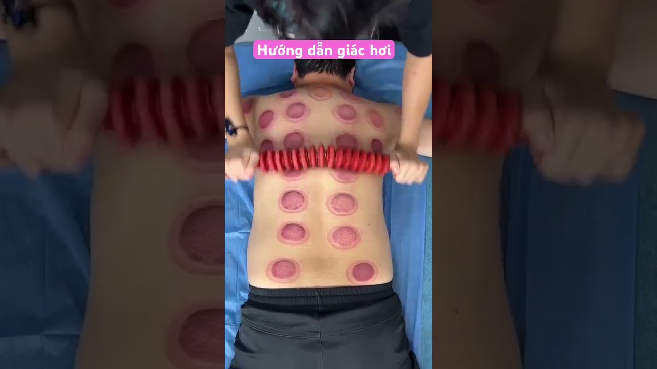 Hướng dẫn gi&aacute;c hơi kiểu trung hoa #remix #giachoi #spa #chamsocsuckhoe #xuhuongyoutube