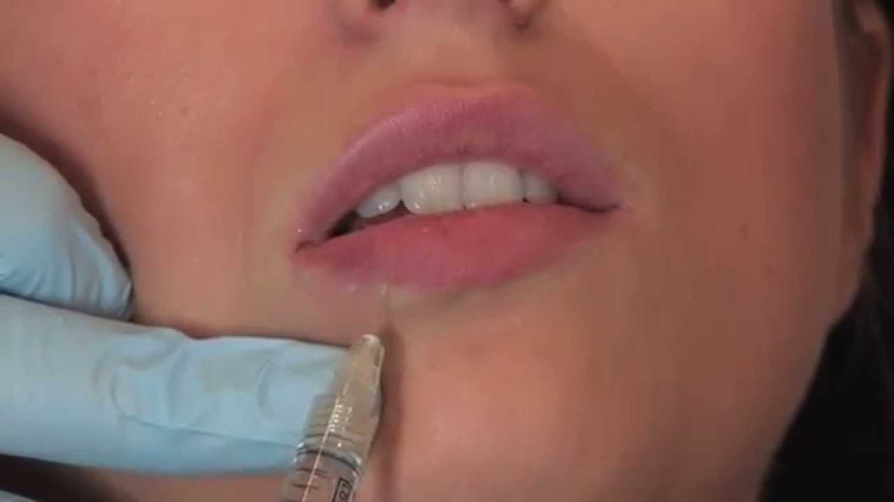 Lippenunterspritzung mit Juvederm Volbella | PULLMANN