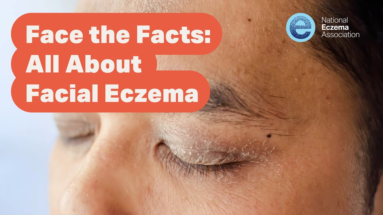 Webinar: Face the Facts—All About Facial Eczema