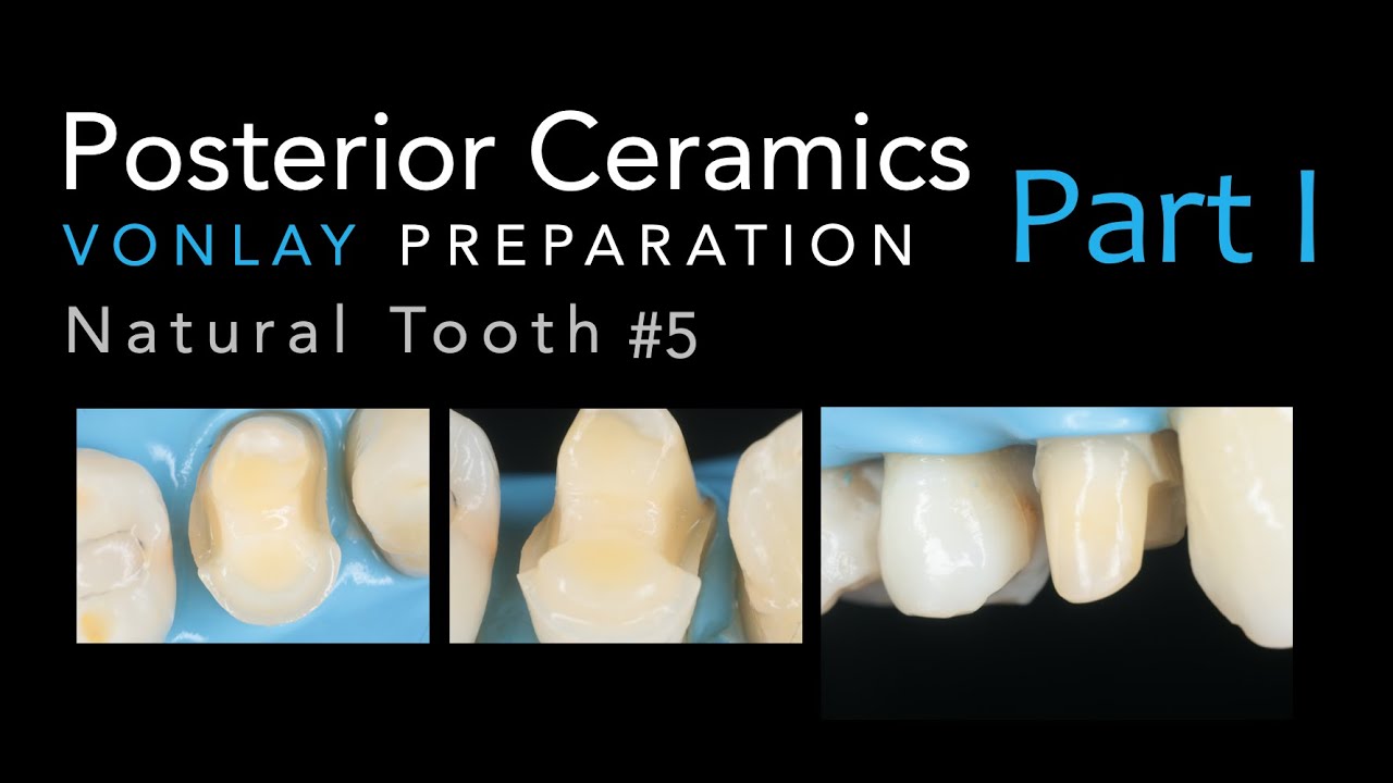 Zirconia Ceramics, Part 1: Vonlay Preparation #5 Natural Tooth