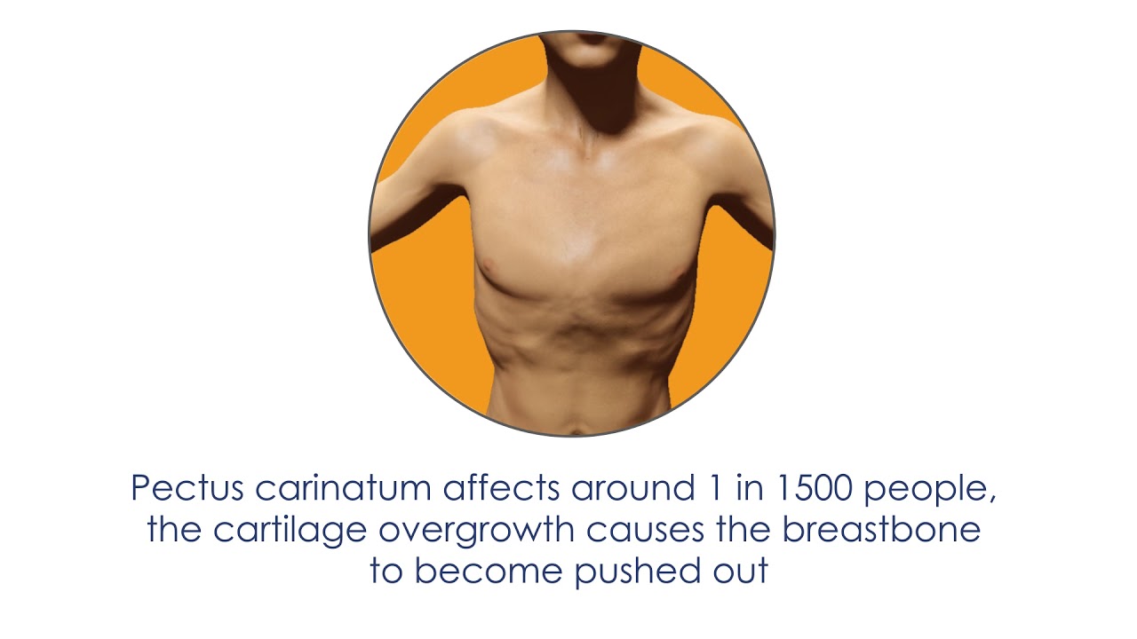 What is Pectus Carinatum?