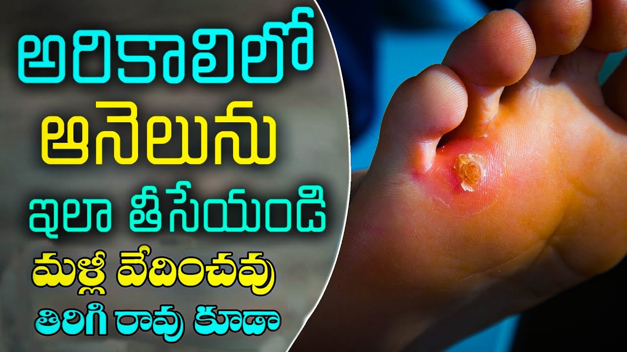 అరికాలి ఆనెలు ను ఇలా తొలగించండి | How to Removal Foot Corn ? Dr.Murali Manohar | #corn