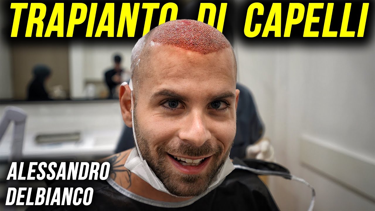 IL TRAPIANTO DI CAPELLI DI ALESSANDRO DELBIANCO
