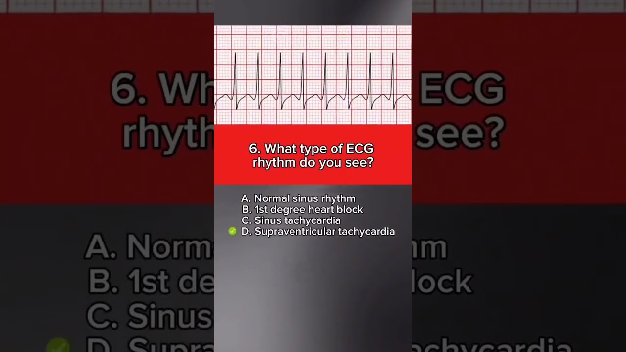 ECG Quiz: The Short Series 1 #shortvideo #medical