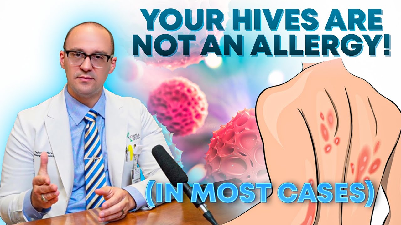 Your Hives are NOT an Allergy!
