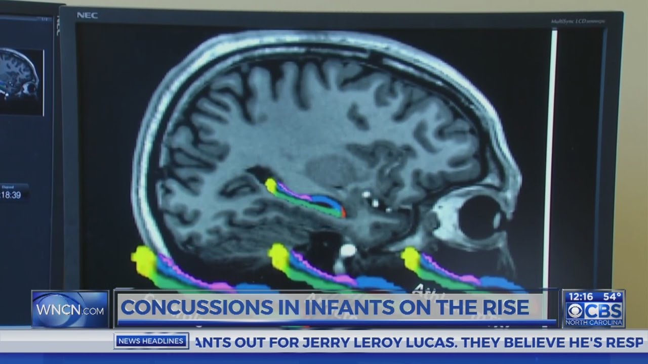 Dr. Campbell: Concussions in infants on the rise