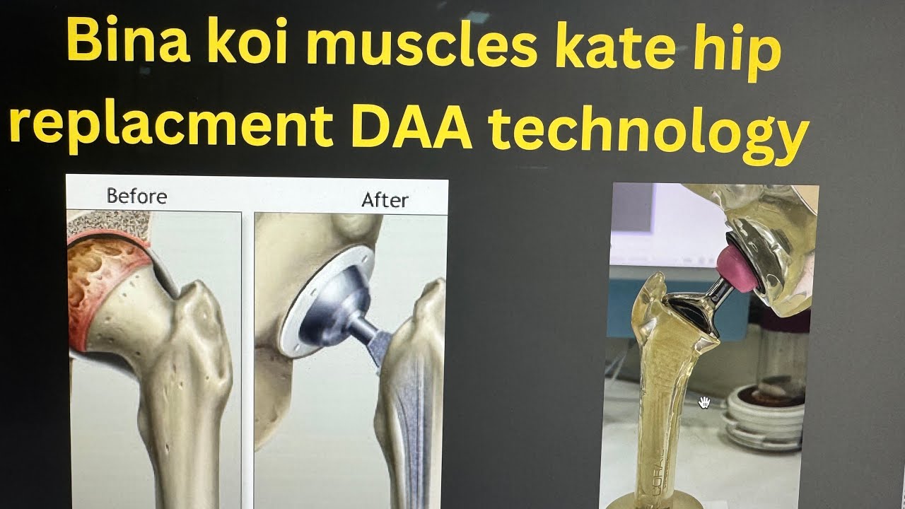 DAA technology se bina koi muscle Kate hip replacement/ fast pain less recovery