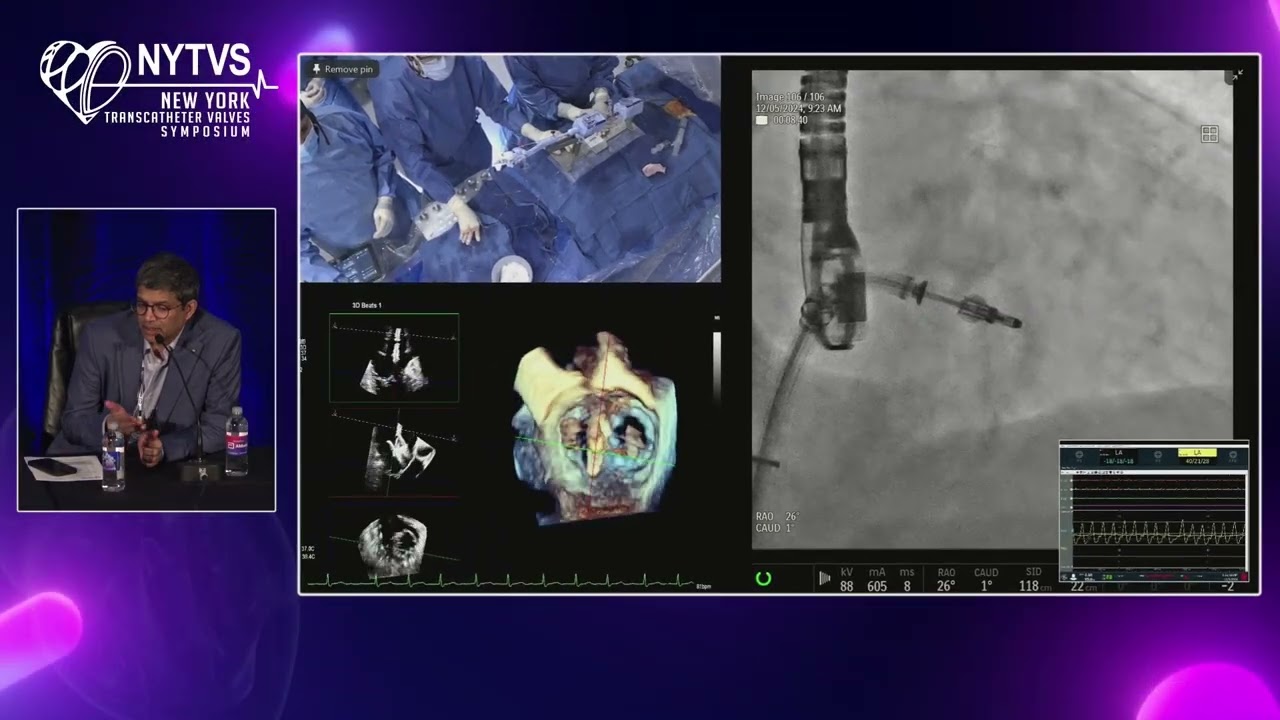 LIVE CASE 1 - Transcatheter Mitral Edge-to-Edge Repair Using MitraClip G4