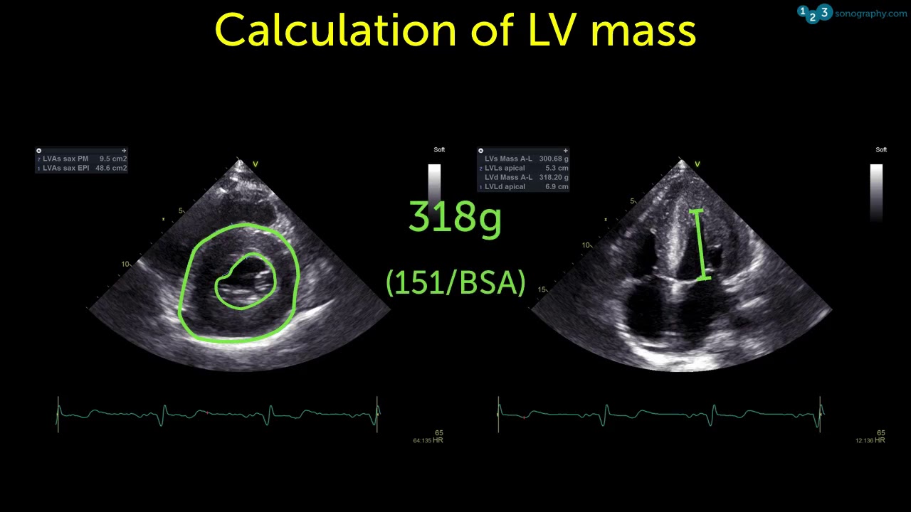 60 seconds of Echo Teaching - Hypertension