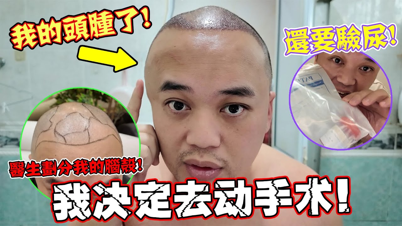 决定去动手术了(植发), 整个真实的体验可以在这里感受得到!!