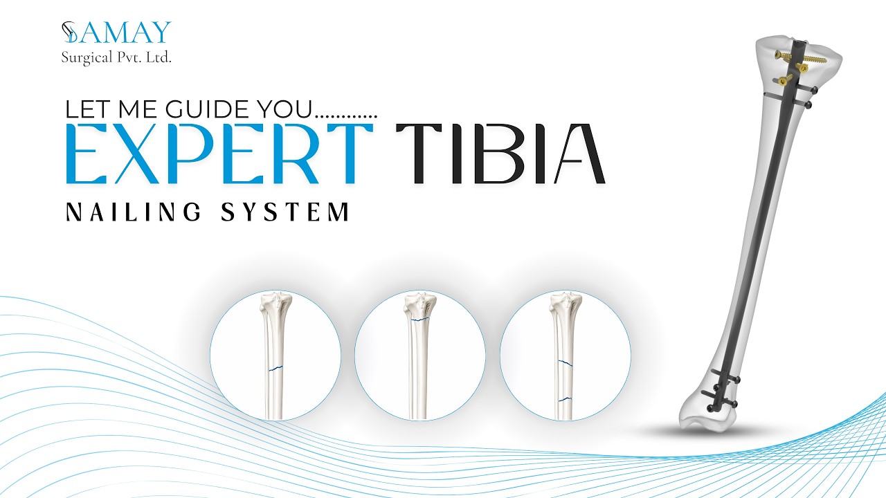 Expert Tibia Nailing System Surgical Technique