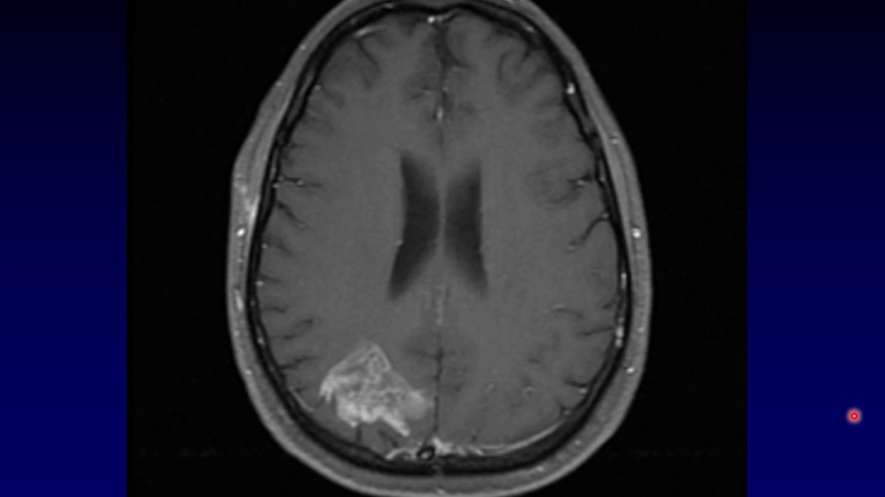 Neurology-Neuroradiology Multidisciplinary Conference