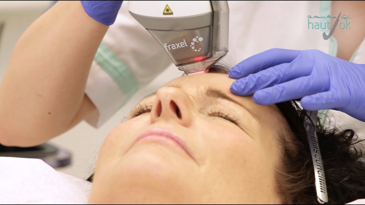 Fraxel DUAL: Laser gegen Falten und Flecken