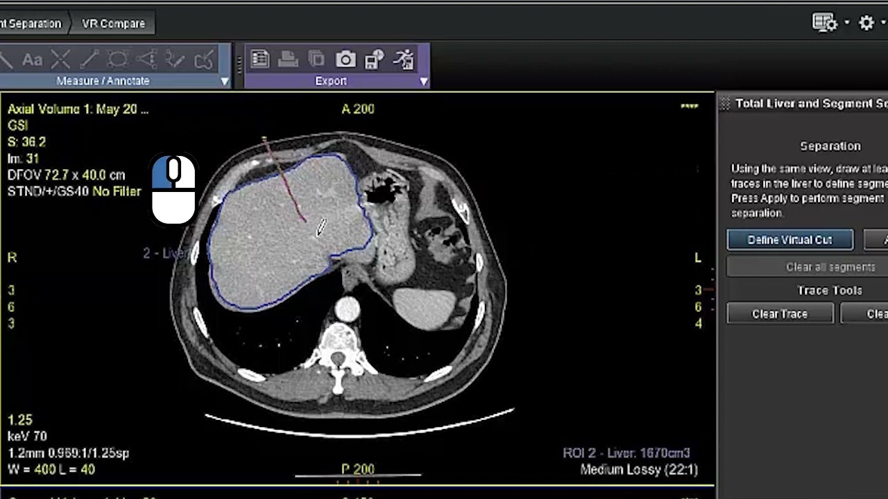 Hepatic VCAR Part II – Segment Separation