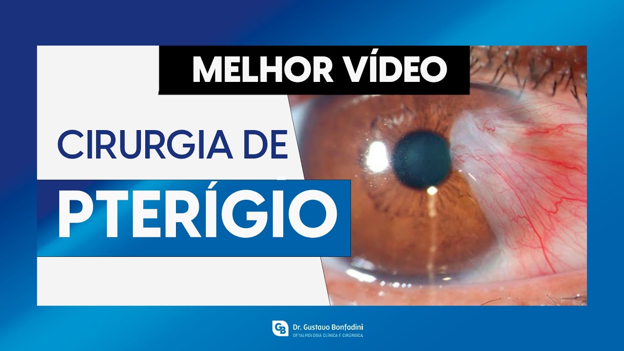 Cirurgia de pterígio – Dr. Gustavo Bonfadini