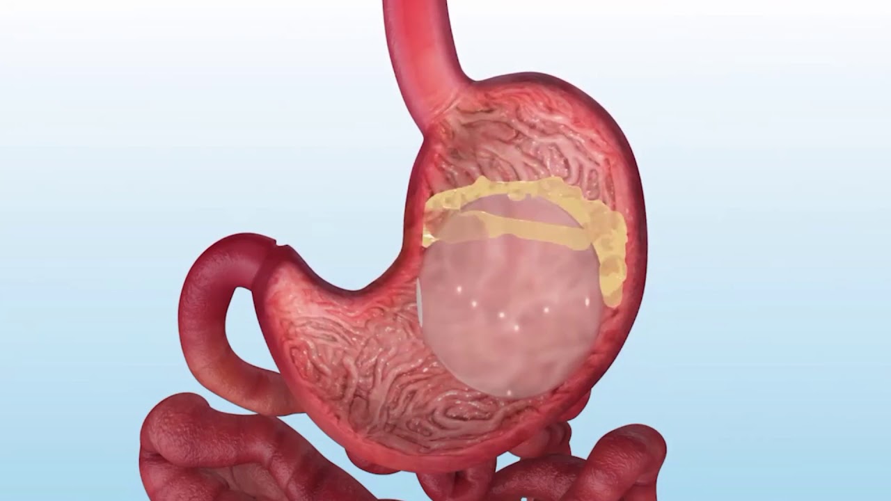 Los tratamientos de Endoscopia Bariátrica más efectivos contra la obesidad