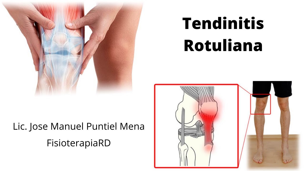 No más errores en la rehabilitación de la Tendinitis Rotuliana (Rodilla del saltador) FisioterapiaRD