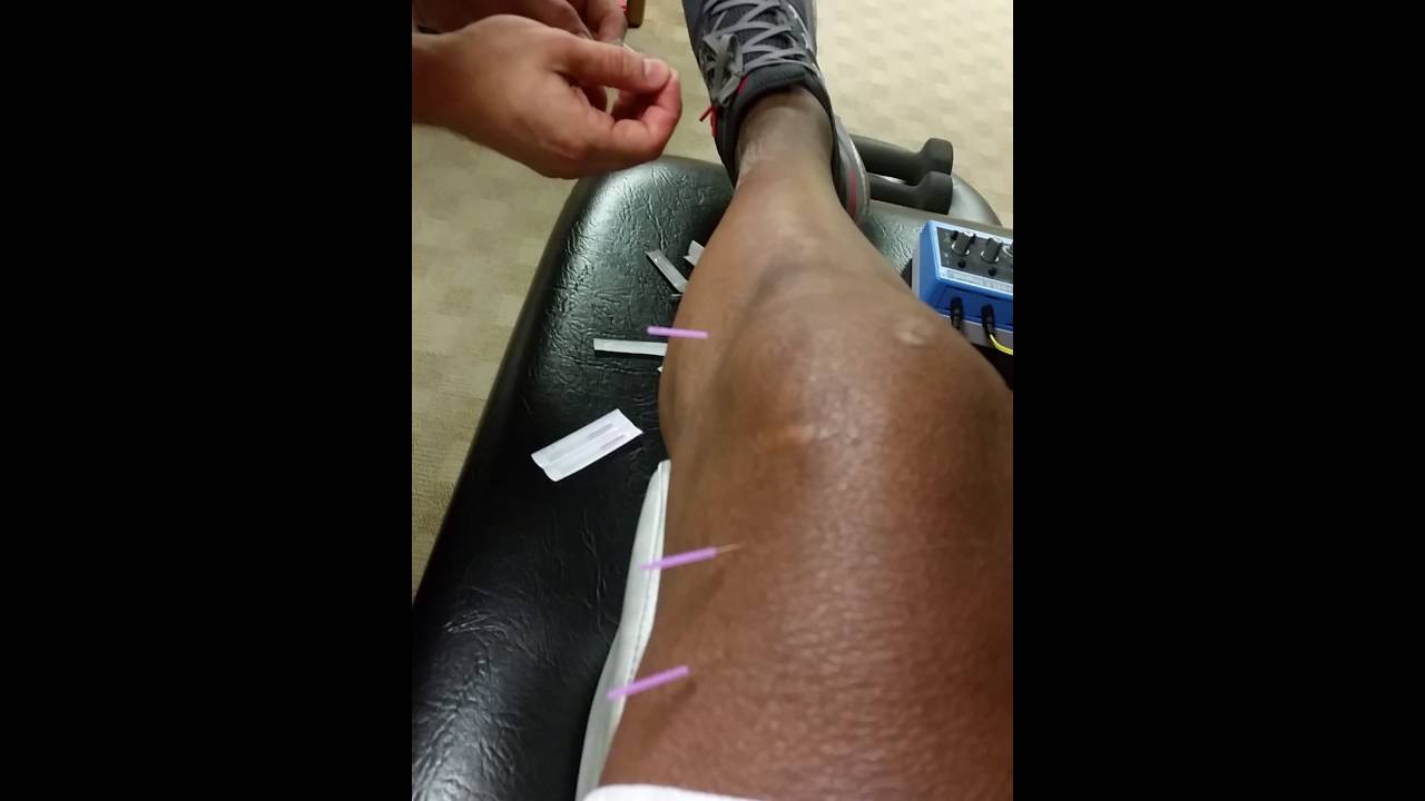 Dry Needling Session@Foothills Physical Therapy Clinic in Phoenix, Arizona