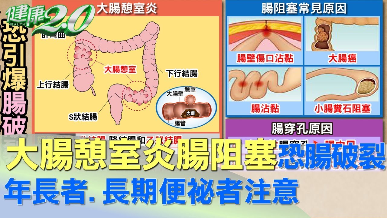 大腸管壁突起0.4公分成憩室 年長.便祕易發炎 健康2.0