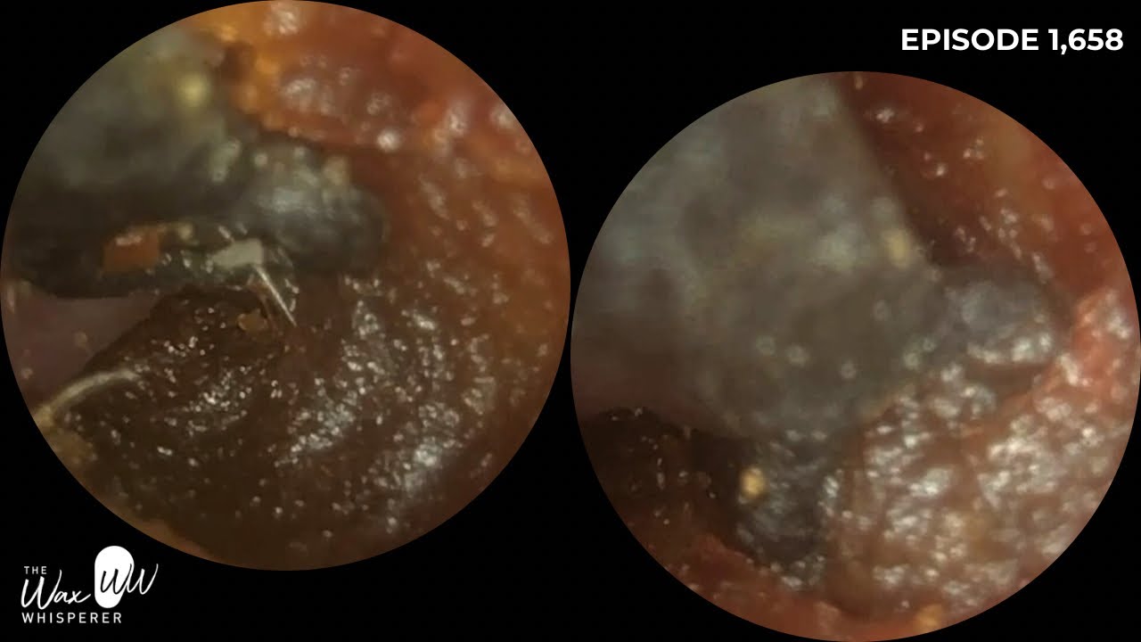1,658 - Manual Endoscopic Ear Wax Removal for Patient With Hyperacusis & Tinnitus | No Microsuction