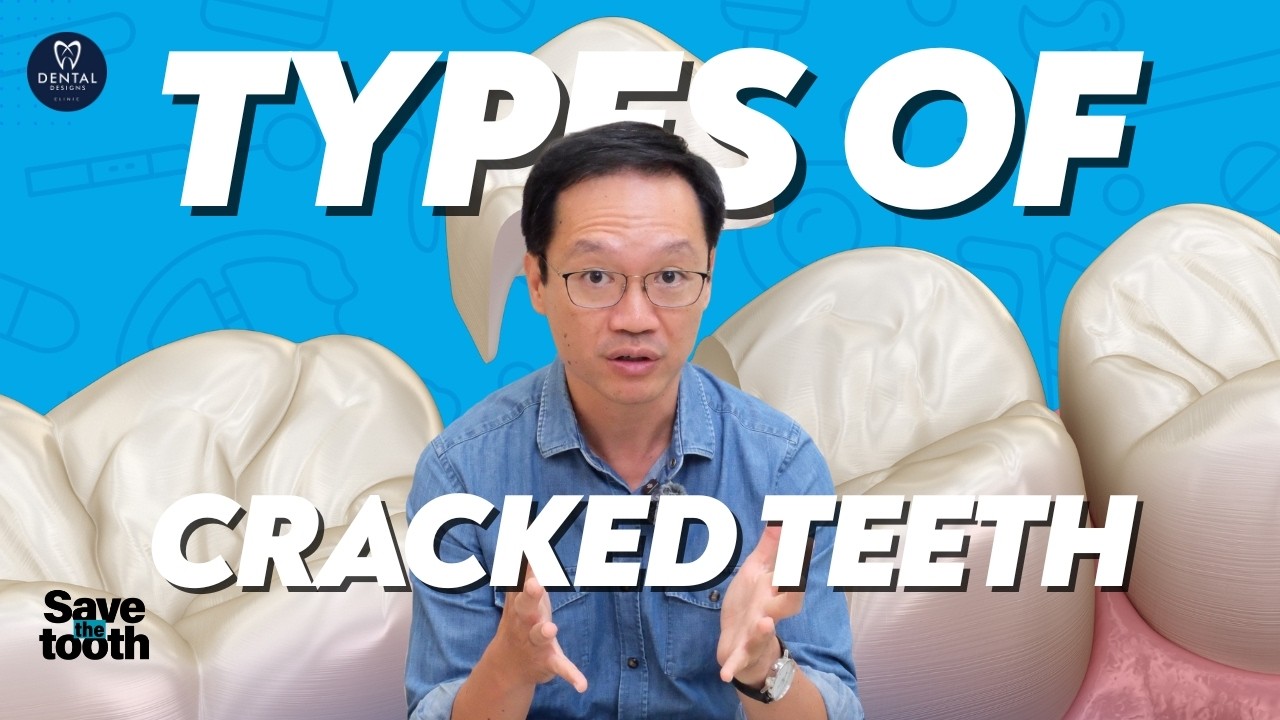 Have a Cracked Tooth? Here’s How Dentists Fix Them | SAVE THE TOOTH SERIES