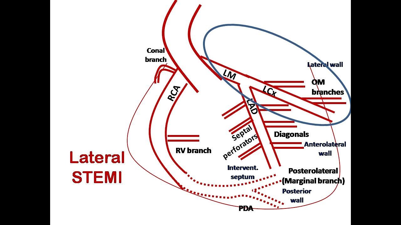 ECG course: Culprit in Lateral STEMI, Dr. Sherif Altoukhy