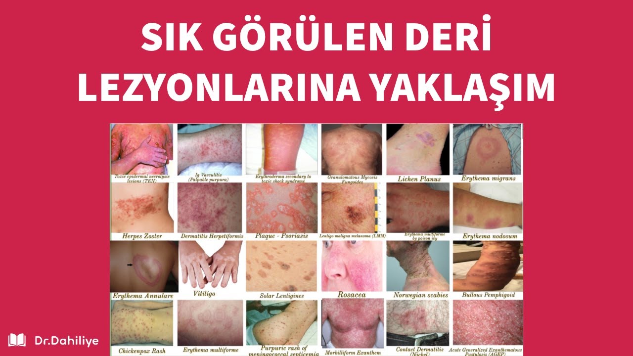 Deri Döküntülerine Yaklaşım | Dr. Hilayda Karakök