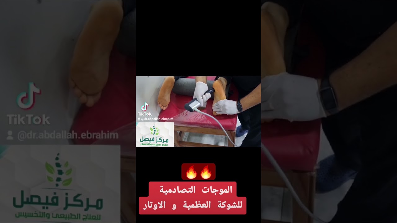 الموجات التصادمية لعلاج الشوكة العظمية و التهاب باطن القدم و التهاب الاوتار في الكوع و الكتف والركبة