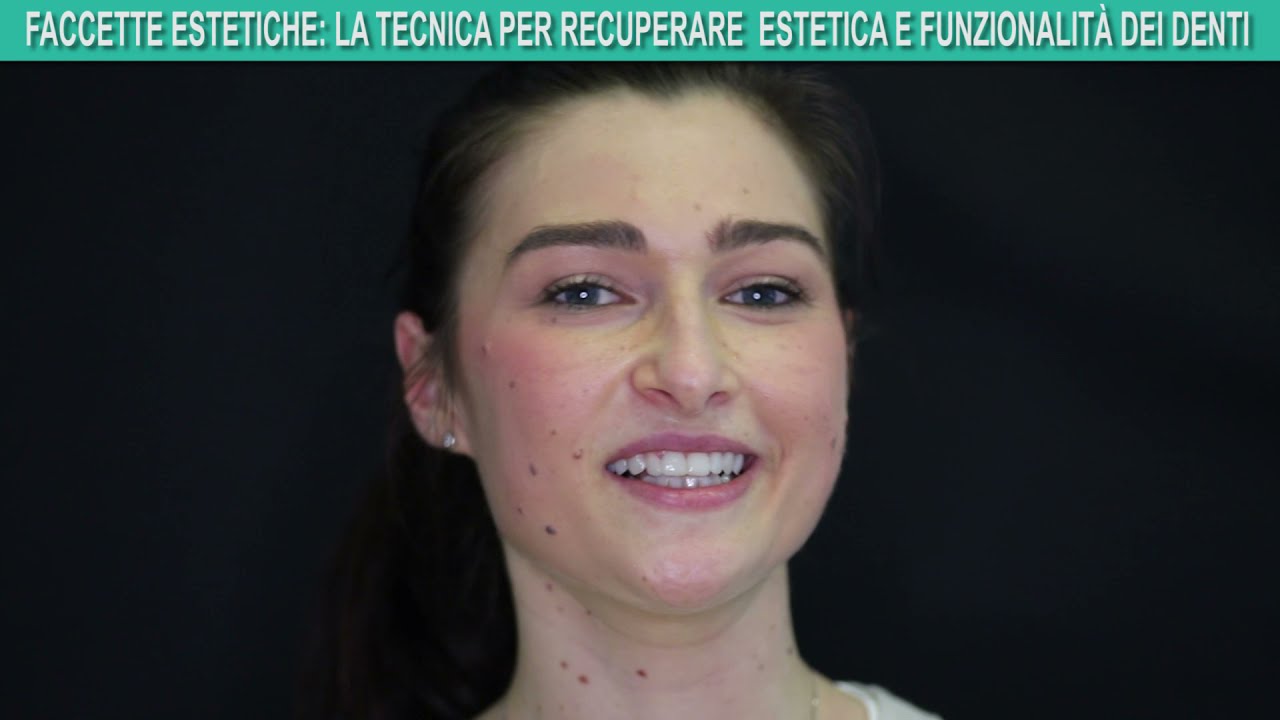 Faccette estetiche: la tecnica per recuperare estetica e funzionalit&agrave; dei denti