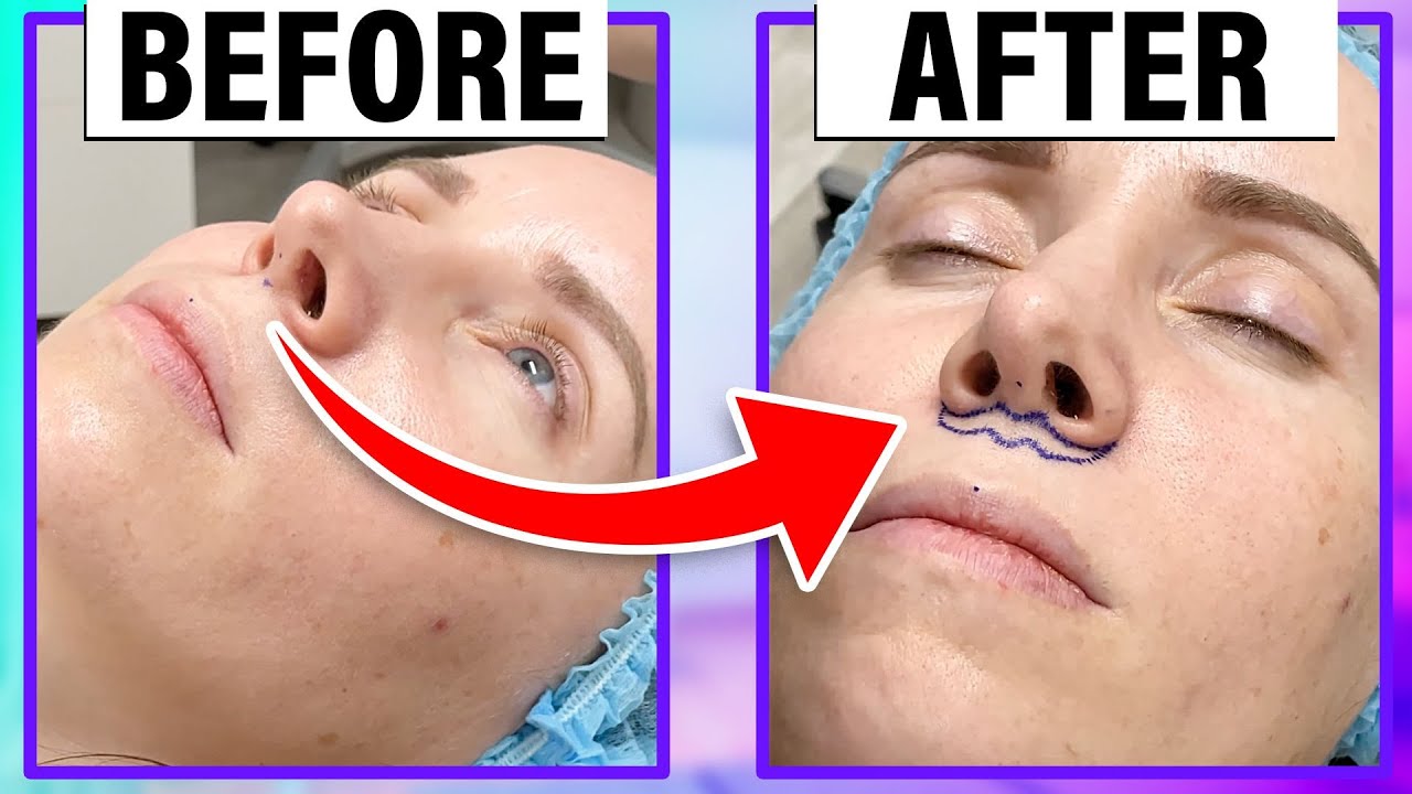Lip Lift Surgical Markings | Dr. Gary Linkov