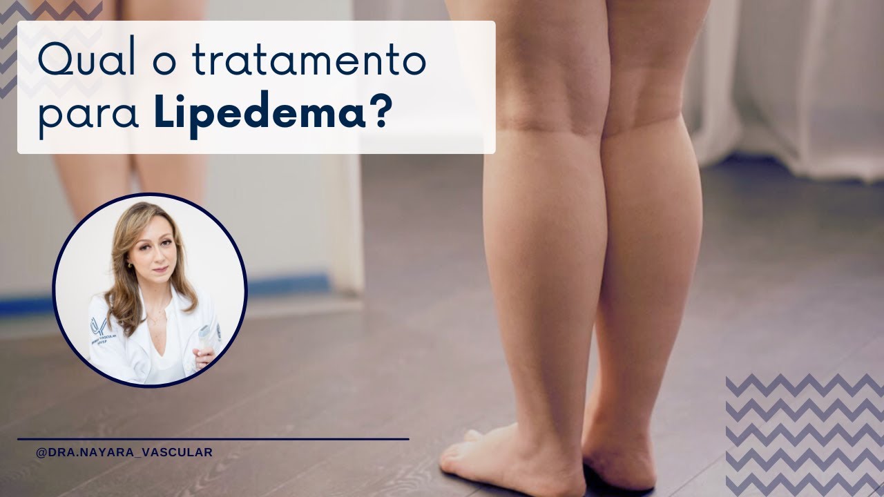 Qual o tratamento para Lipedema? - Dra. Nayara Cioffi Batagini - Cirurgia Vascular e Endovascular