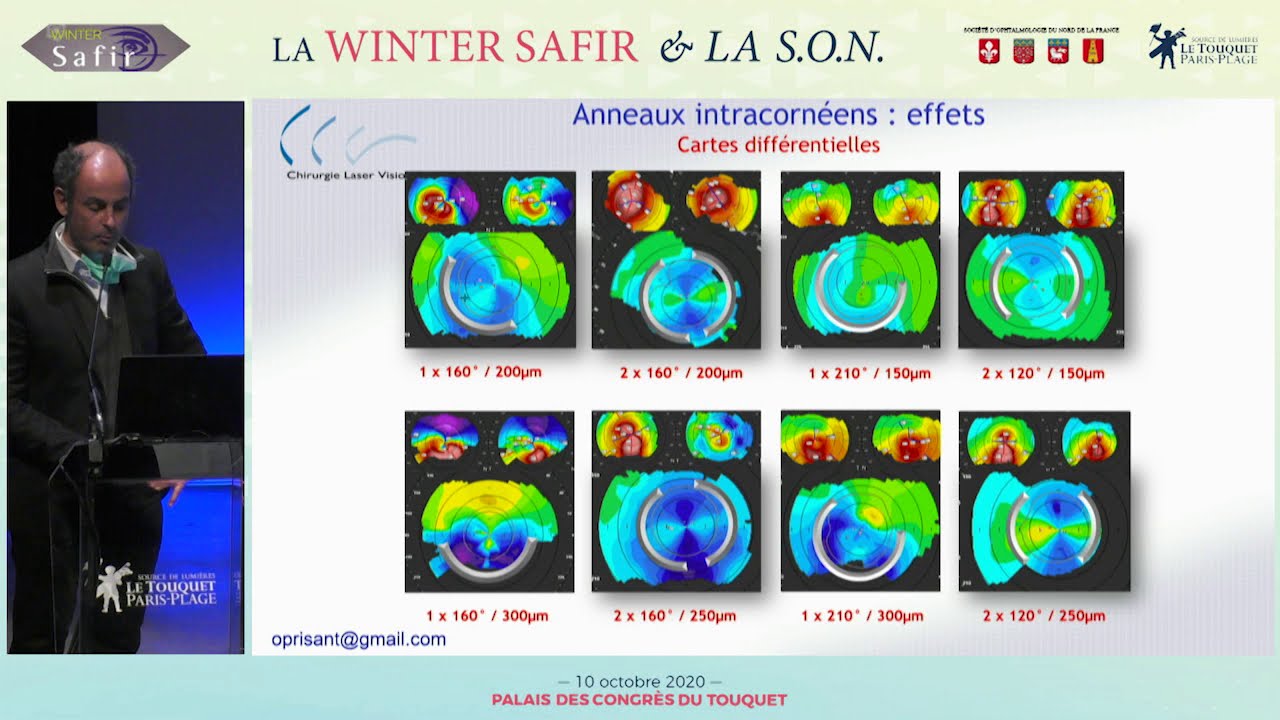 SAFIR Touquet anneaux intra-cornéens dans le kératocône (2020) Docteur Olivier Prisant
