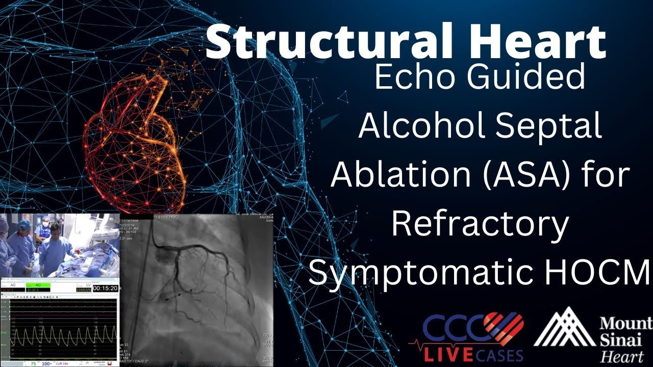 Echo Guided Alcohol Septal Ablation (ASA) for Refractory Symptomatic HOCM – July 2019