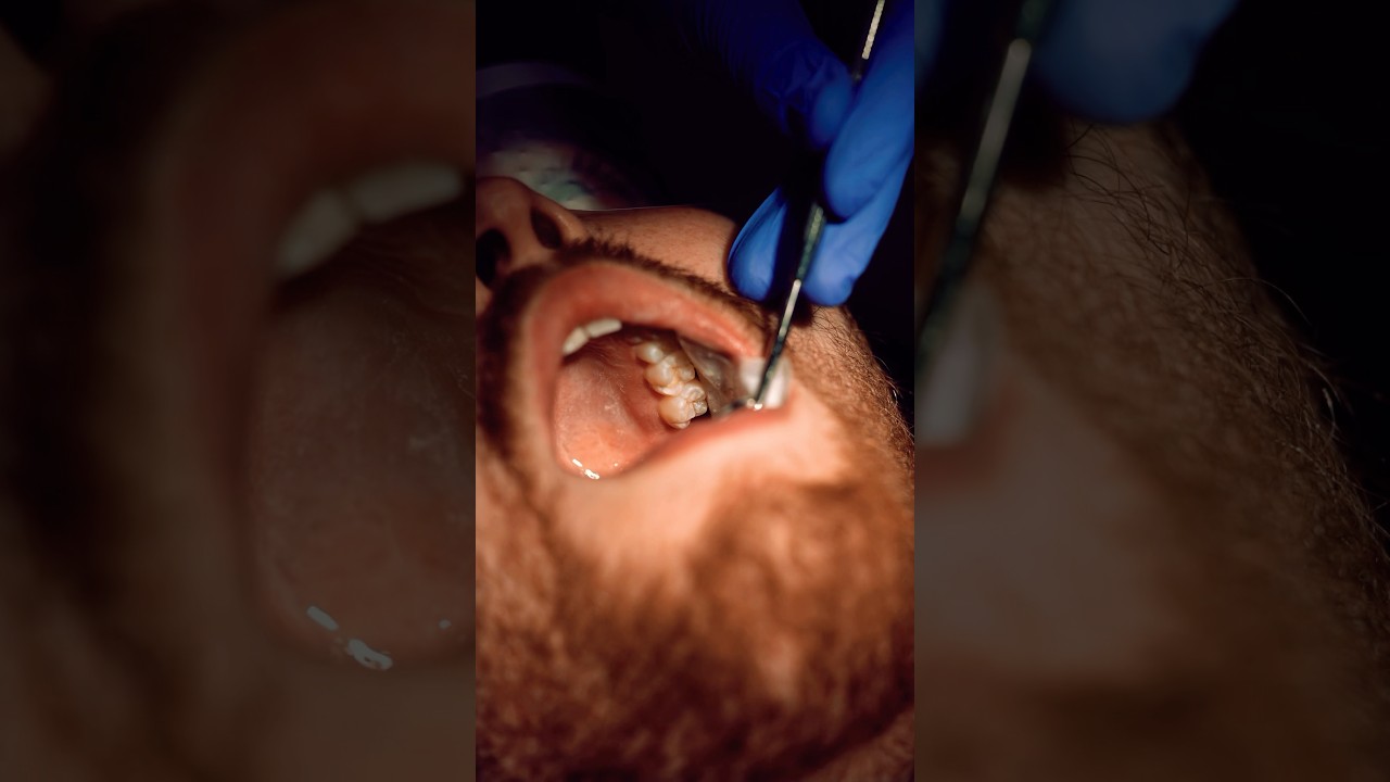 Can you Still get Veneers with Periodontal Disease 🦠? #shorts #periodontist  #patienteducation