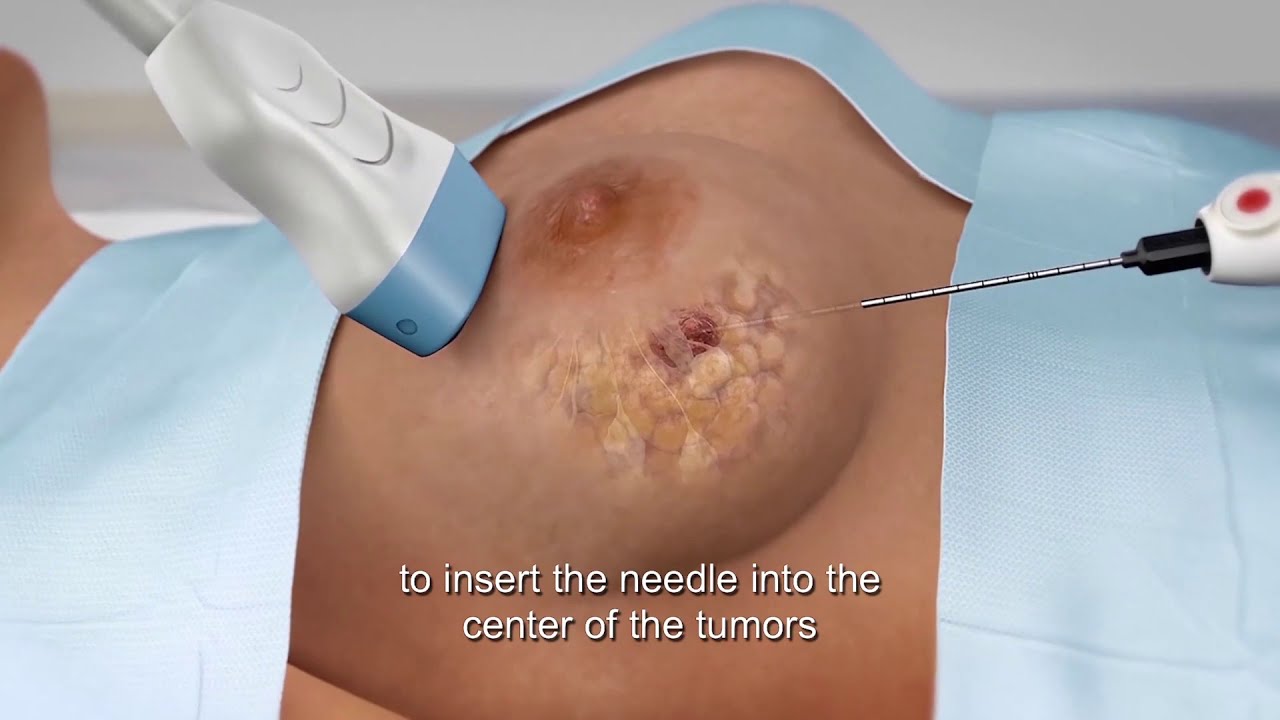 Prof E. Fukuma -  Cryoablation for Breast Cancer