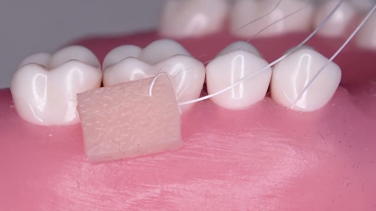 Graft Insertion Technique