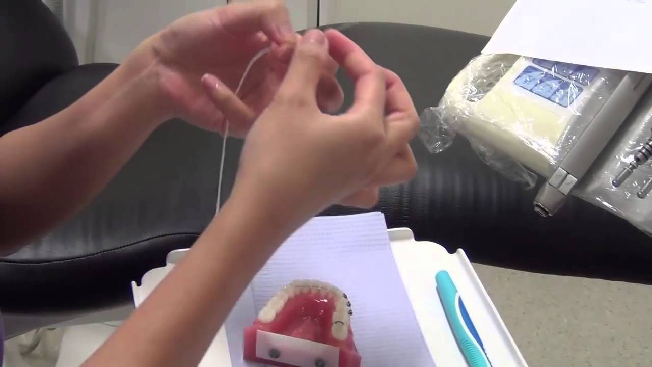 How to Clean Your Fixed Orthodontic Wire Retainer