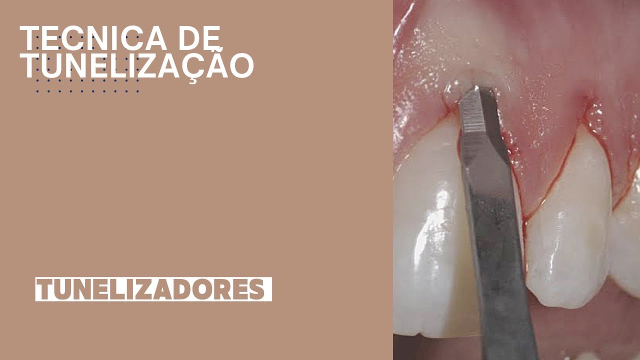 Técnica de tunelização, Ricardo Kern , desenvolvido pela Supremo…