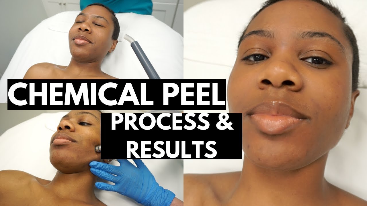 MICRODERM + CHEMICAL PEEL| Full Process + Check Ins & Results!