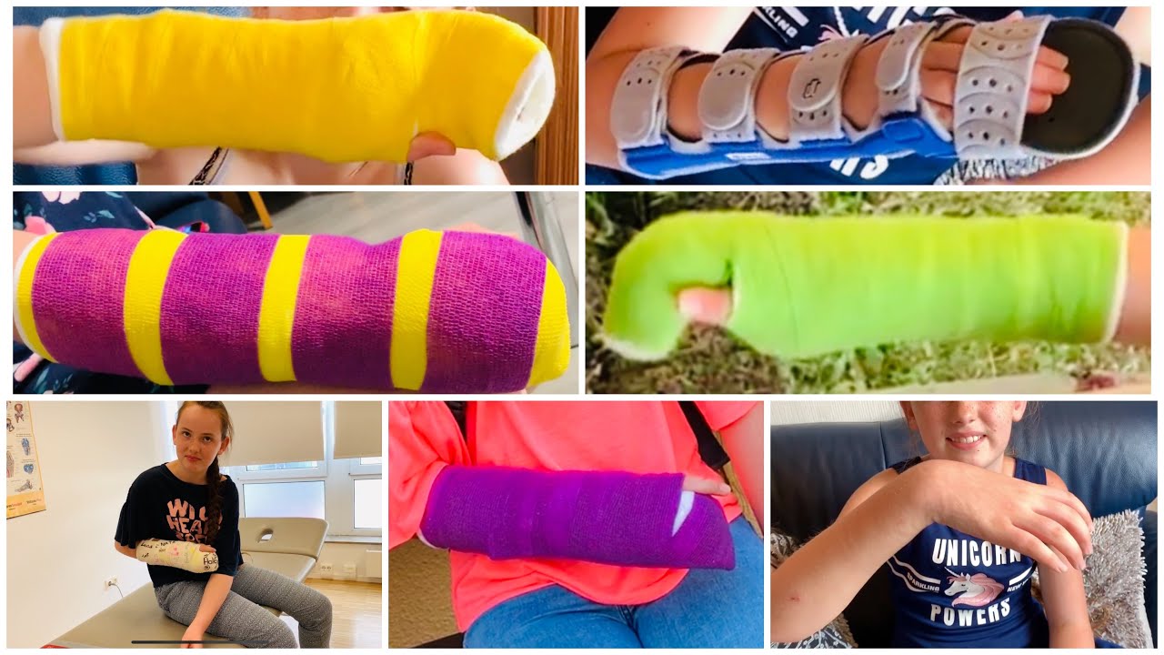 Kranken Verlauf 😆 Gips Kontrolle 😣 Gips Farben ☺️ endlich Gips ab und Schiene dran 😅