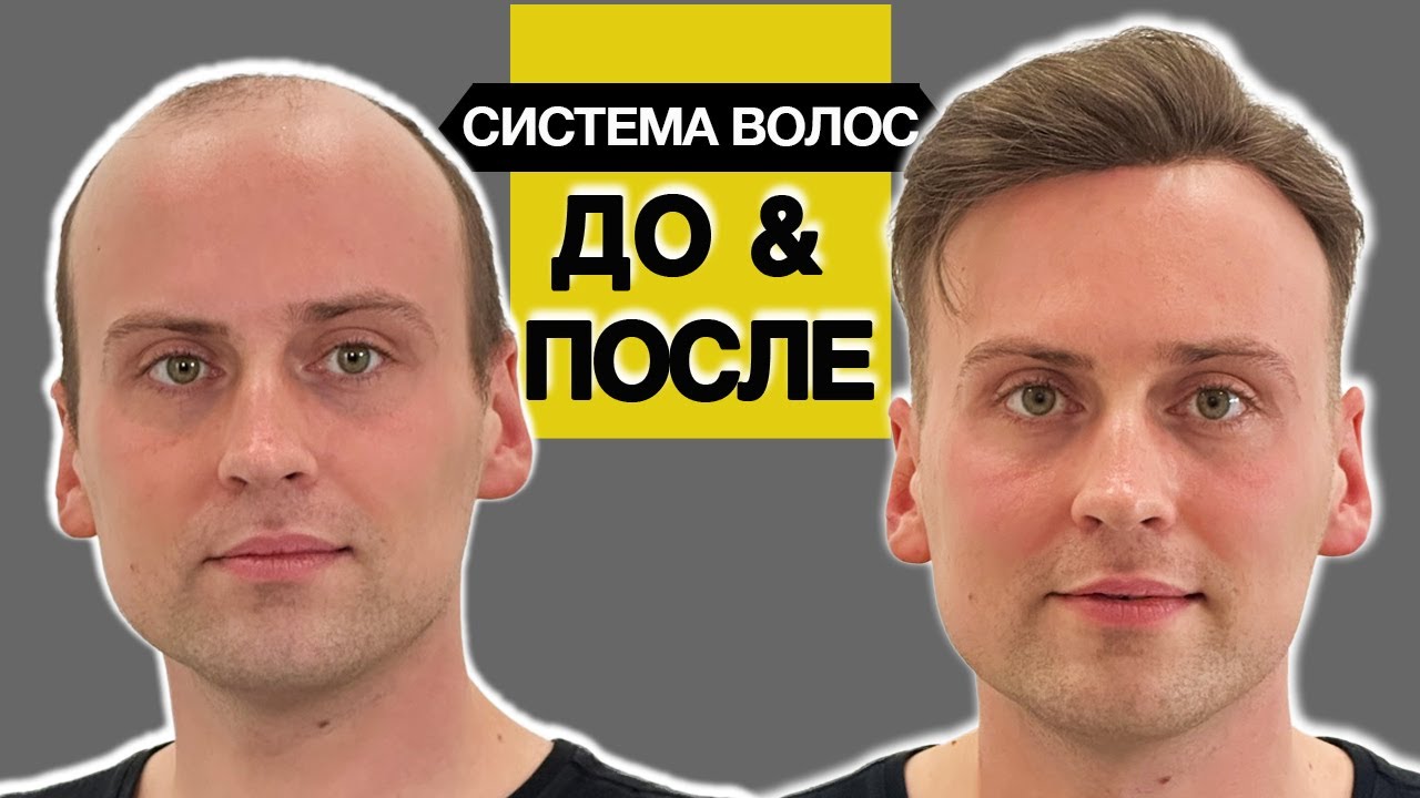 Жизнь в системе волос несколько лет, заметно ли? Ассортимент систем волос при алопеции у мужчин.