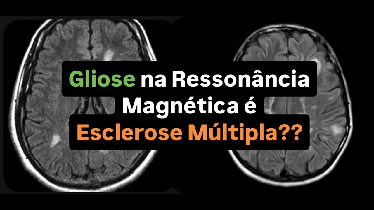 GLIOSE/MICROANGIOPATIA na Ressonância Magnética é Esclerose Múltipla?