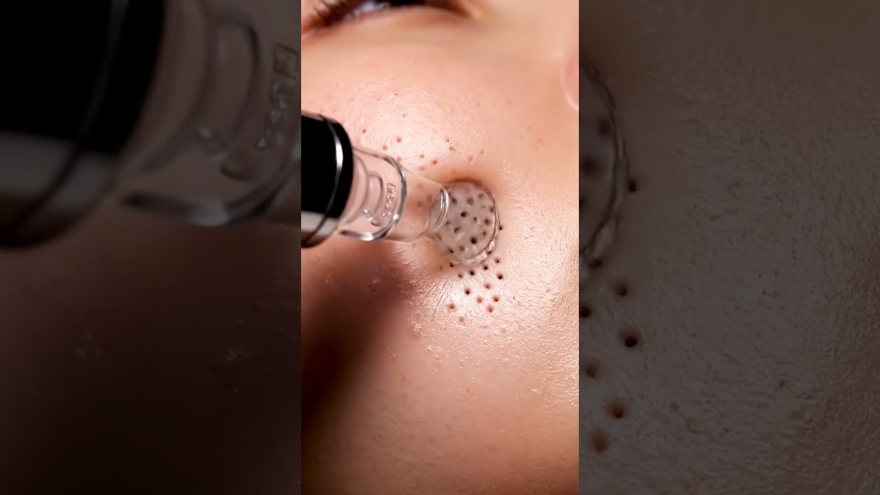 &ldquo;Thousands of Tiny Blackheads Sucked Out &mdash; Ultra Macro Vacuum Cleanse&rdquo;