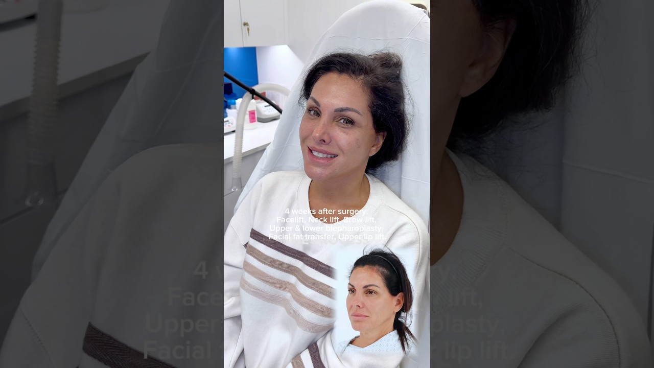 4 weeks after surgery: Facelift, Neck lift, Brow lift, Upper & lower blepharoplasty