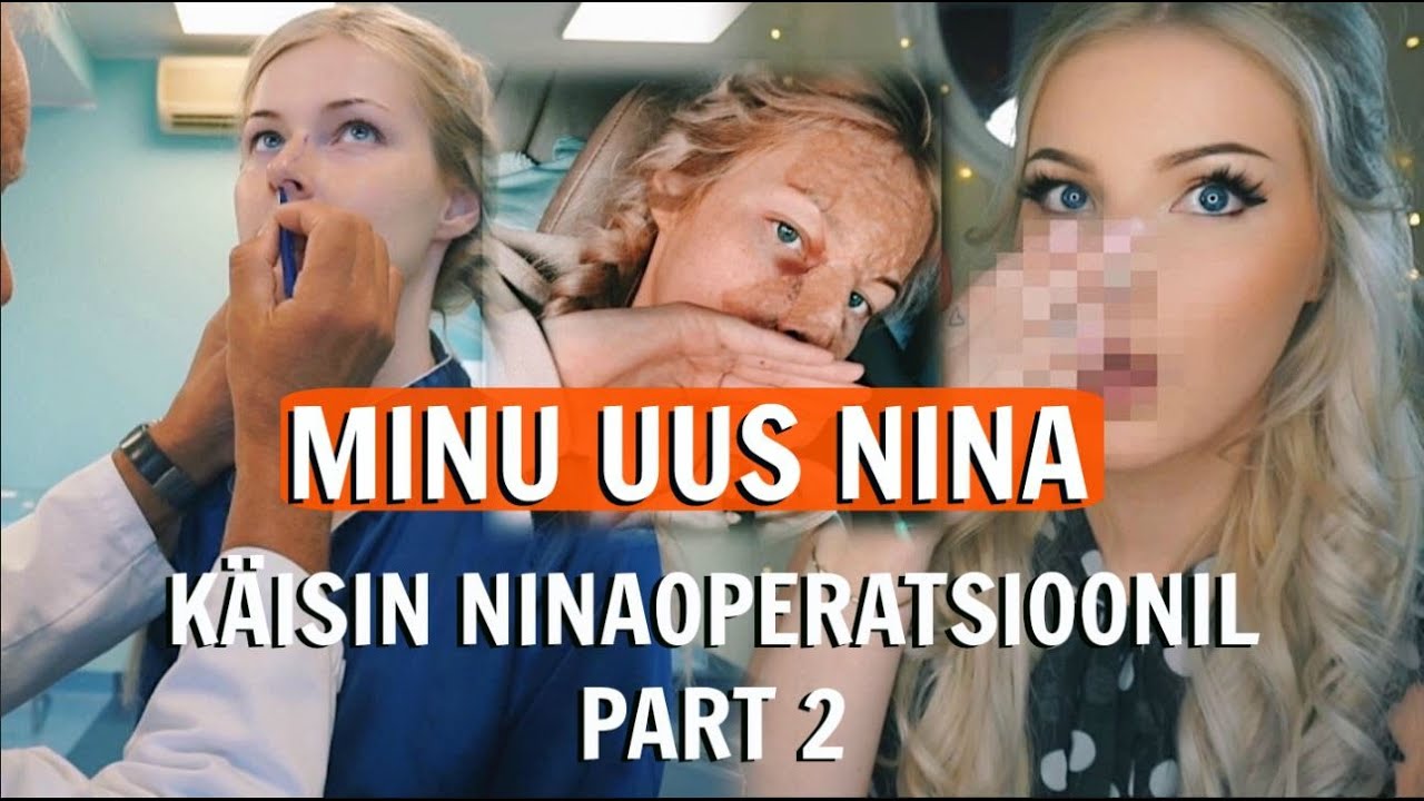 MINU UUS NINA | käisin ninaoperatsioonil part 2