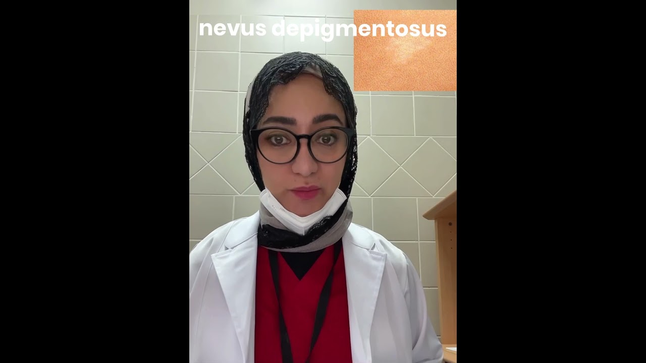 الوحمة زائلة الصباغ Nevus Depigmentosus